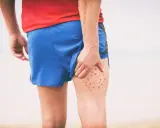 Mężczyzna w czerwonej koszulce i niebieskich spodenkach sportowych dotyka uda, na którym widoczne są czerwone krosty.