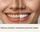 Porównanie uśmiechu: zęby przed i po wybieleniu. Zobacz, jak łatwo uzyskać olśniewającą biel i naturalną pewność siebie.