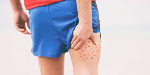 Mężczyzna w czerwonej koszulce i niebieskich spodenkach sportowych dotyka uda, na którym widoczne są czerwone krosty.