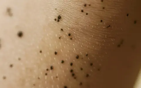 Zbliżenie na skórę z licznymi ciemnymi pieprzykami i włoskami. Wygląda jak fragment ciemne kolana.