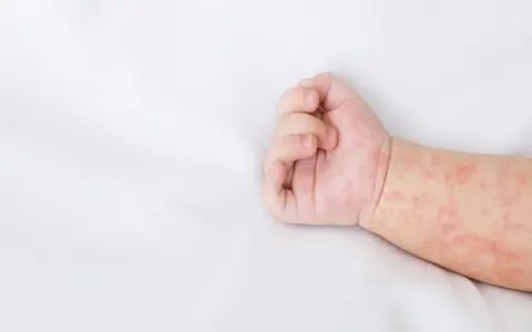 Rączka niemowlaka z czerwonymi plamkami, które przypominają kaszkę mannę.