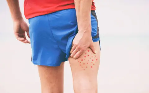 Mężczyzna w czerwonej koszulce i niebieskich spodenkach sportowych dotyka uda, na którym widoczne są czerwone krosty.