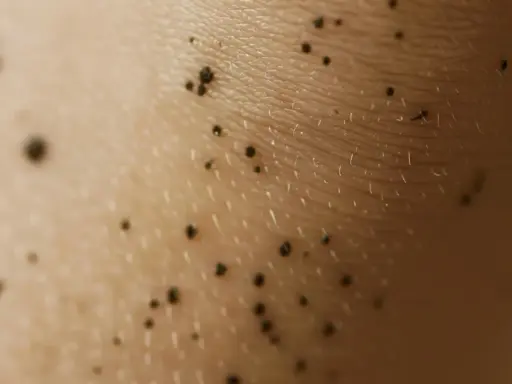 Zbliżenie na skórę z licznymi ciemnymi pieprzykami i włoskami. Wygląda jak fragment ciemne kolana.