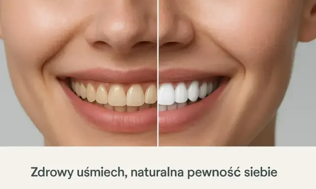 Porównanie uśmiechu: zęby przed i po wybieleniu. Zobacz, jak łatwo uzyskać olśniewającą biel i naturalną pewność siebie.