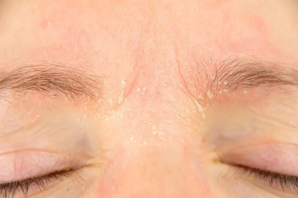 Skóra między brwiami jest zaczerwieniona i łuszczy się, co może być jednym z retinol efekty uboczne.