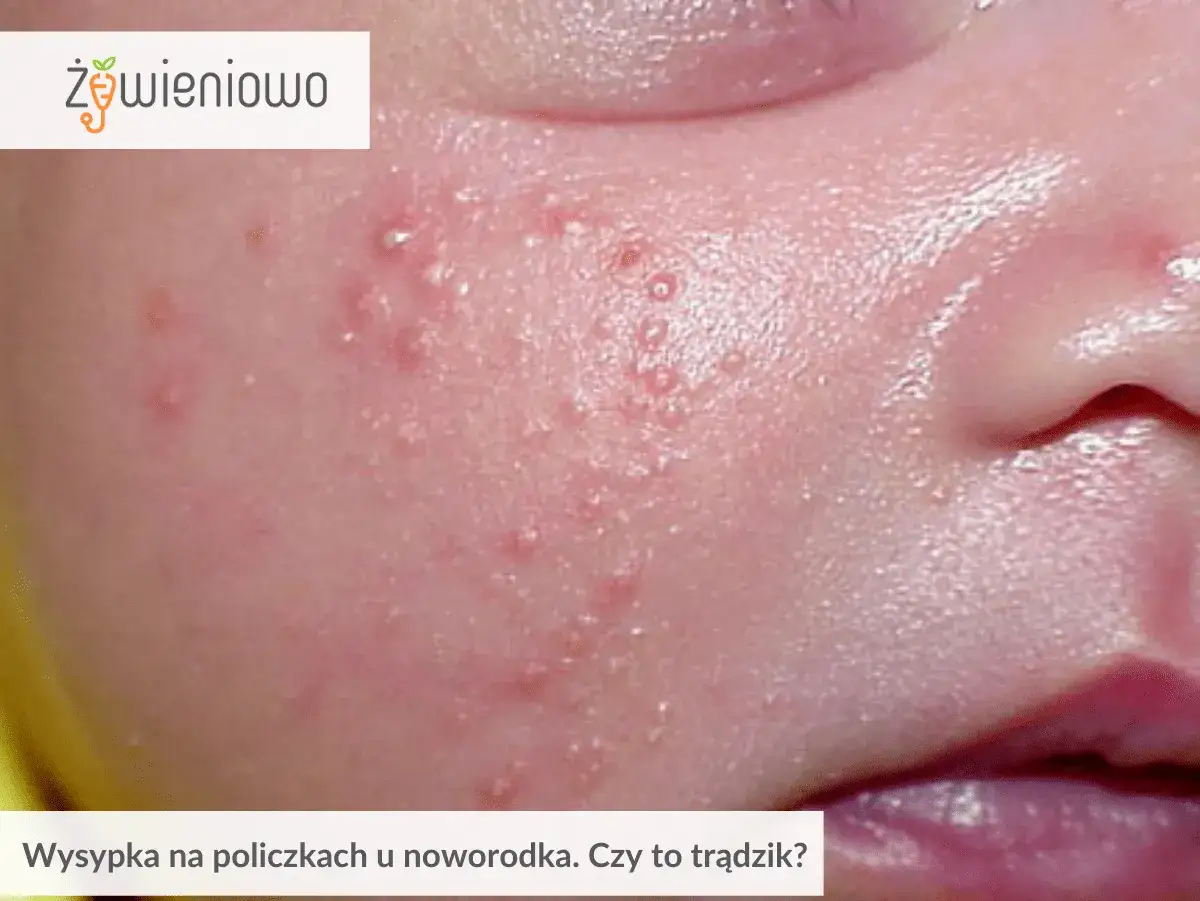 Delikatna skóra niemowlaka pokryta drobnymi krostkami, przypominającymi kaszkę mannę. Czy to trądzik niemowlęcy?